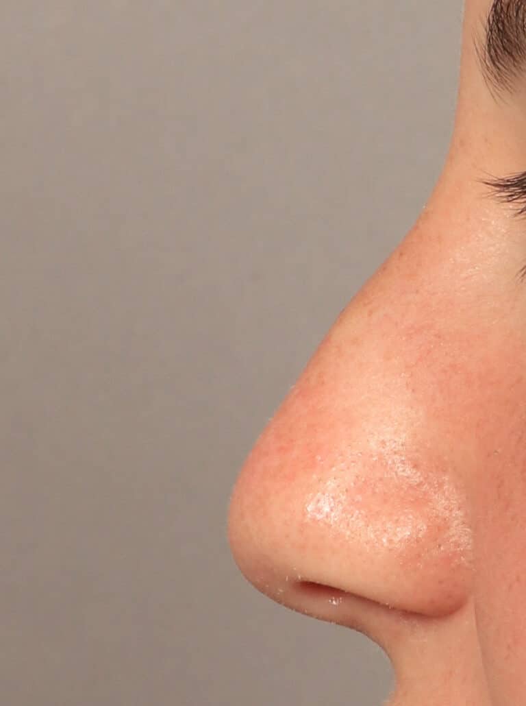 Before Image: Rhinoplasty (10 Months Post-Op) - left-side