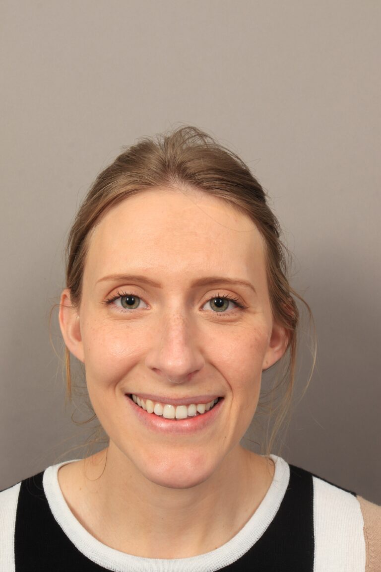 Before Image: Rhinoplasty (3 Months Post-Op) - front