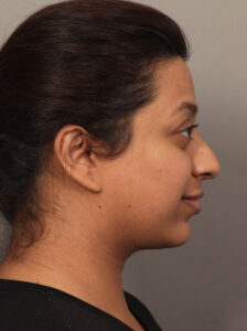 Before Image: Rhinoplasty & Alarplasty (6 Months Post-Op)