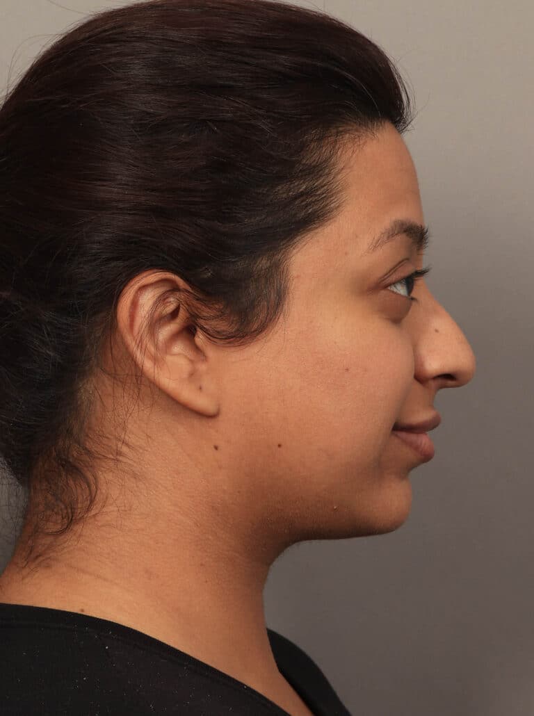 Before Image: Rhinoplasty & Alarplasty (6 Months Post-Op) - right-side