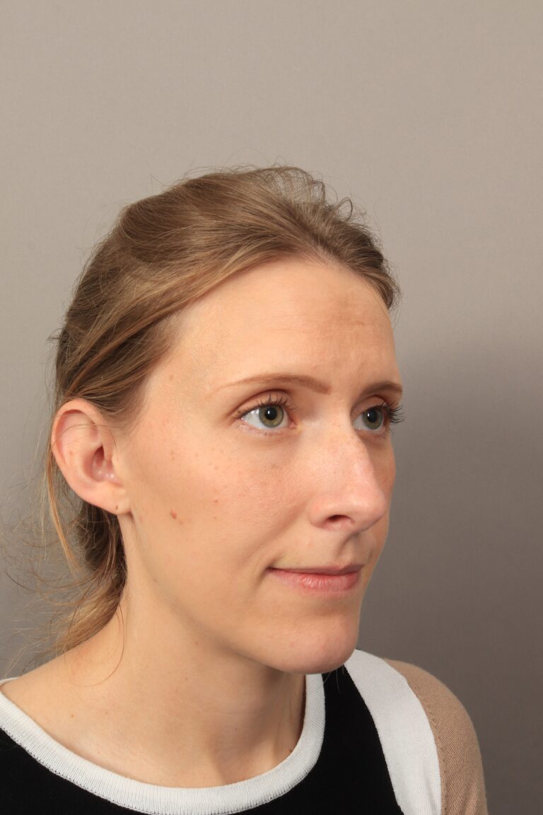 Before Image: Rhinoplasty (3 Months Post-Op) - right-front-oblique
