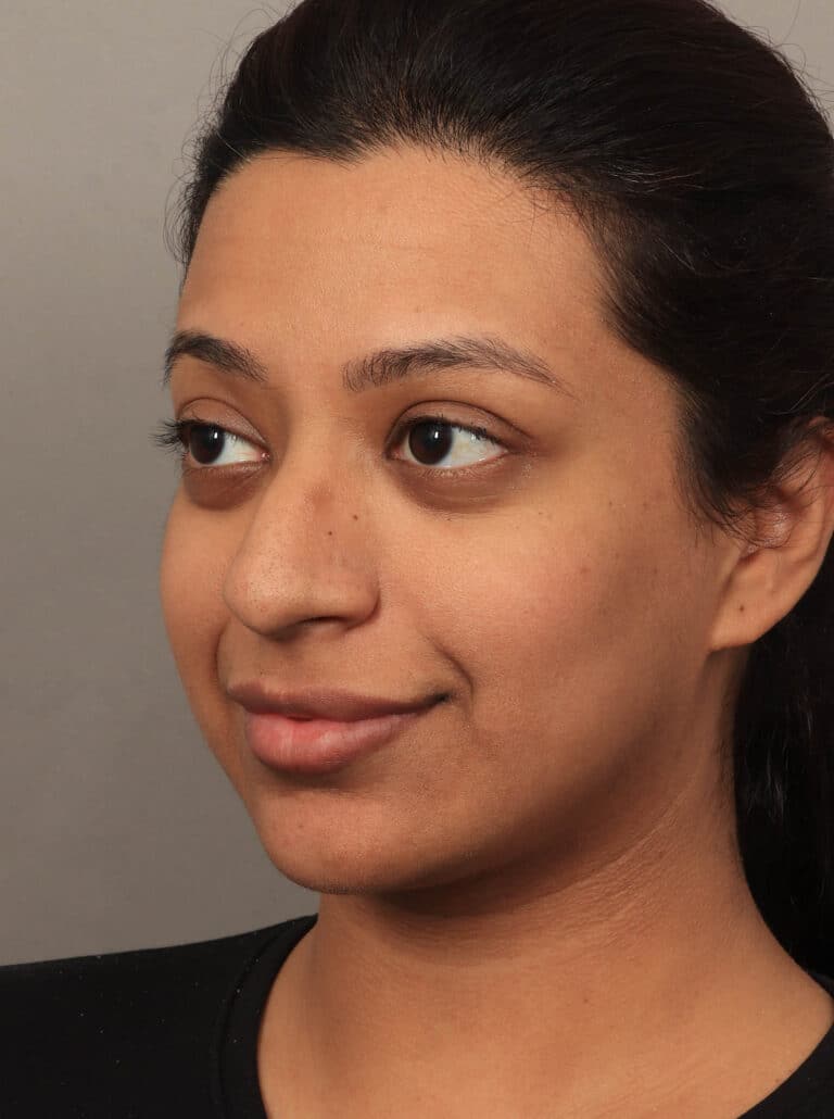 Before Image: Rhinoplasty & Alarplasty (6 Months Post-Op) - left-front-oblique
