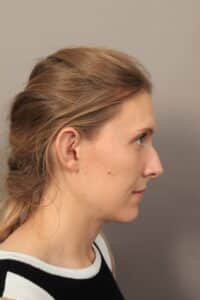 Before Image: Rhinoplasty (3 Months Post-Op)