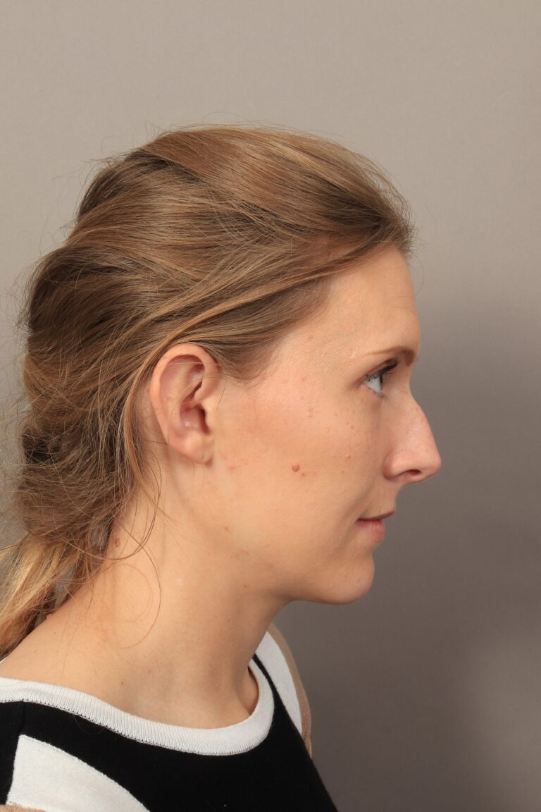Before Image: Rhinoplasty (3 Months Post-Op) - right-side