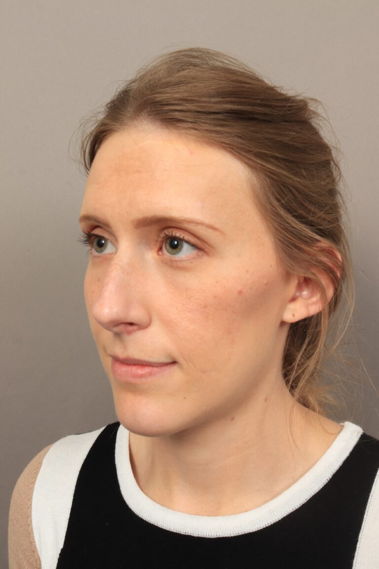 Before Image: Rhinoplasty (3 Months Post-Op) - left-front-oblique