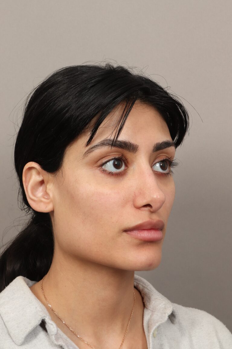 Before Image: Revision Rhinoplasty (1 Month Post-Op) - right-front-oblique