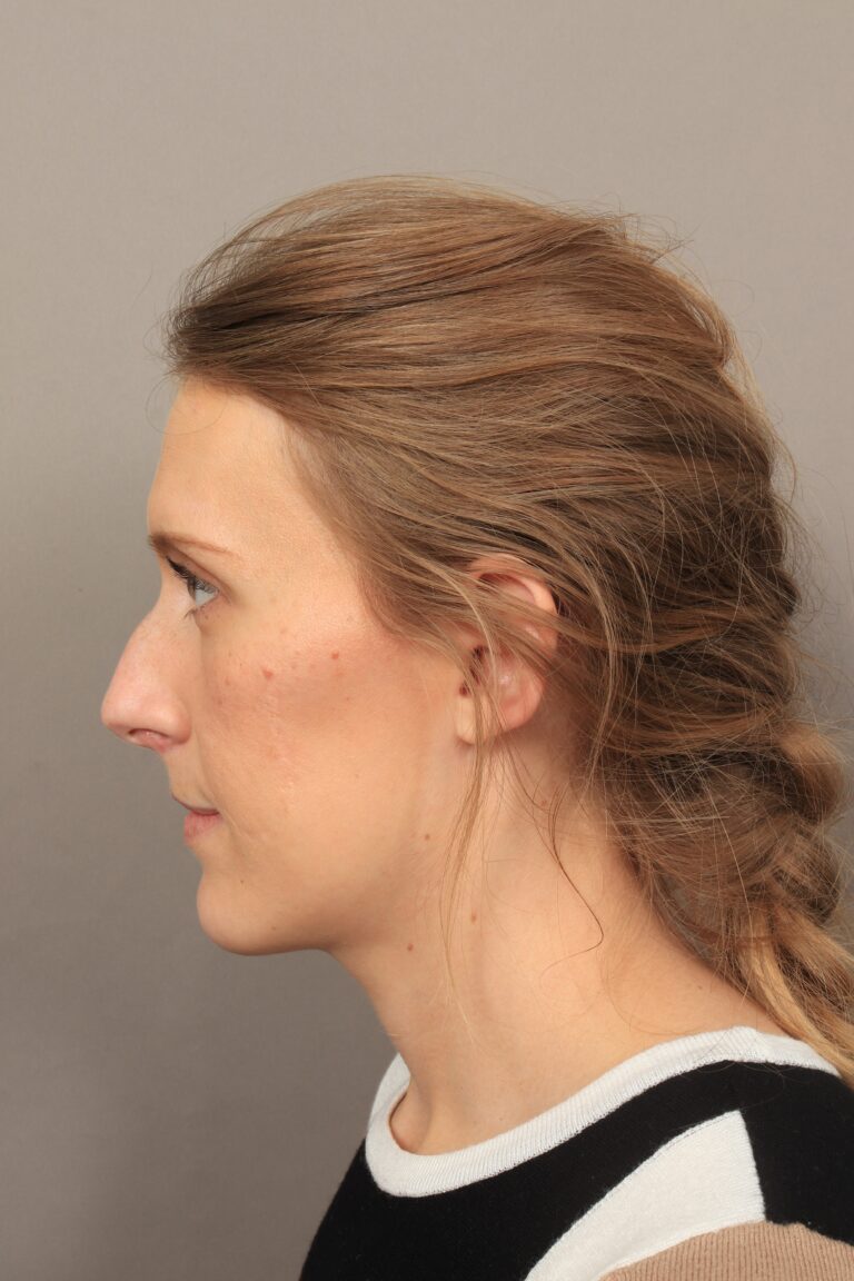 Before Image: Rhinoplasty (3 Months Post-Op) - left-side