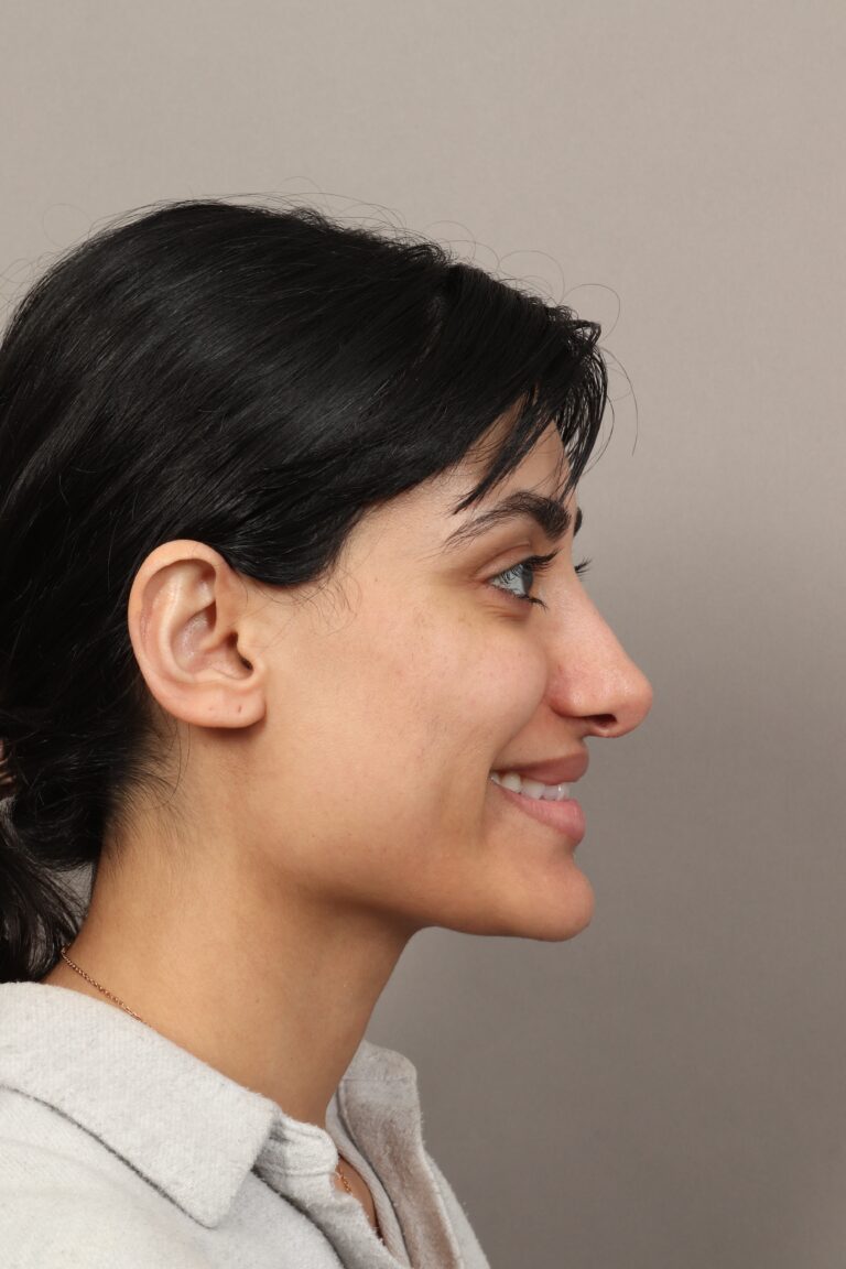 Before Image: Revision Rhinoplasty (1 Month Post-Op) - right-side