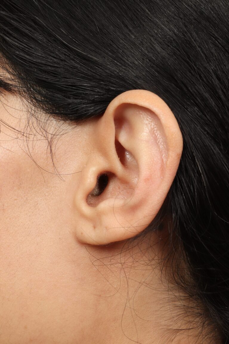 Before Image: Revision Rhinoplasty (1 Month Post-Op) - left-front-oblique