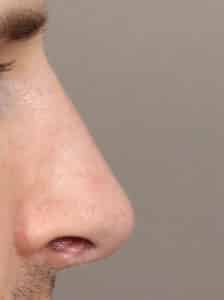 After Image: Rhinoplasty (9.5 Months Post-Op)