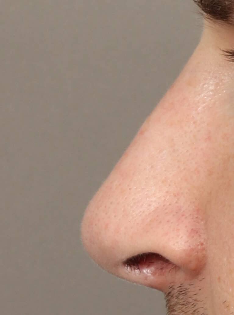 After Image: Rhinoplasty (9.5 Months Post-Op) - left-side