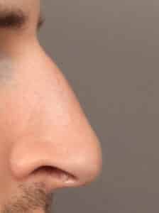 Before Image: Rhinoplasty (9.5 Months Post-Op)
