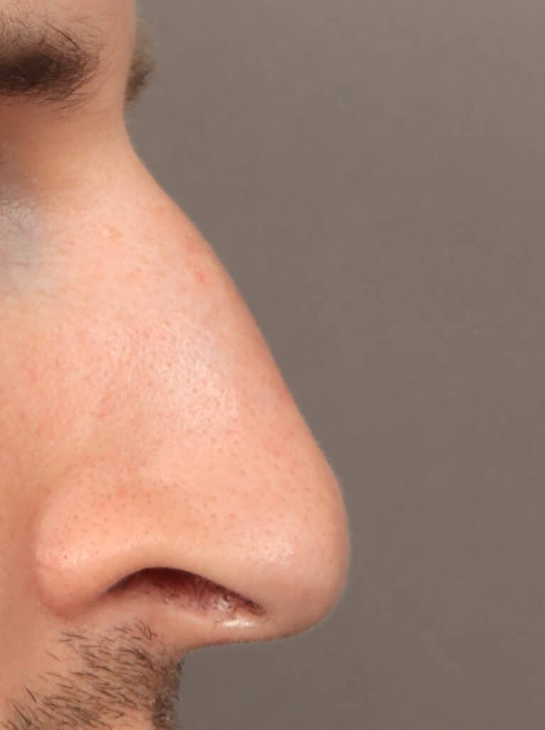 Before Image: Rhinoplasty (9.5 Months Post-Op) - right-side