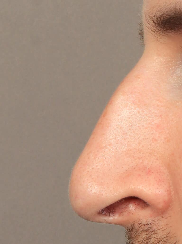 Before Image: Rhinoplasty (9.5 Months Post-Op) - left-side