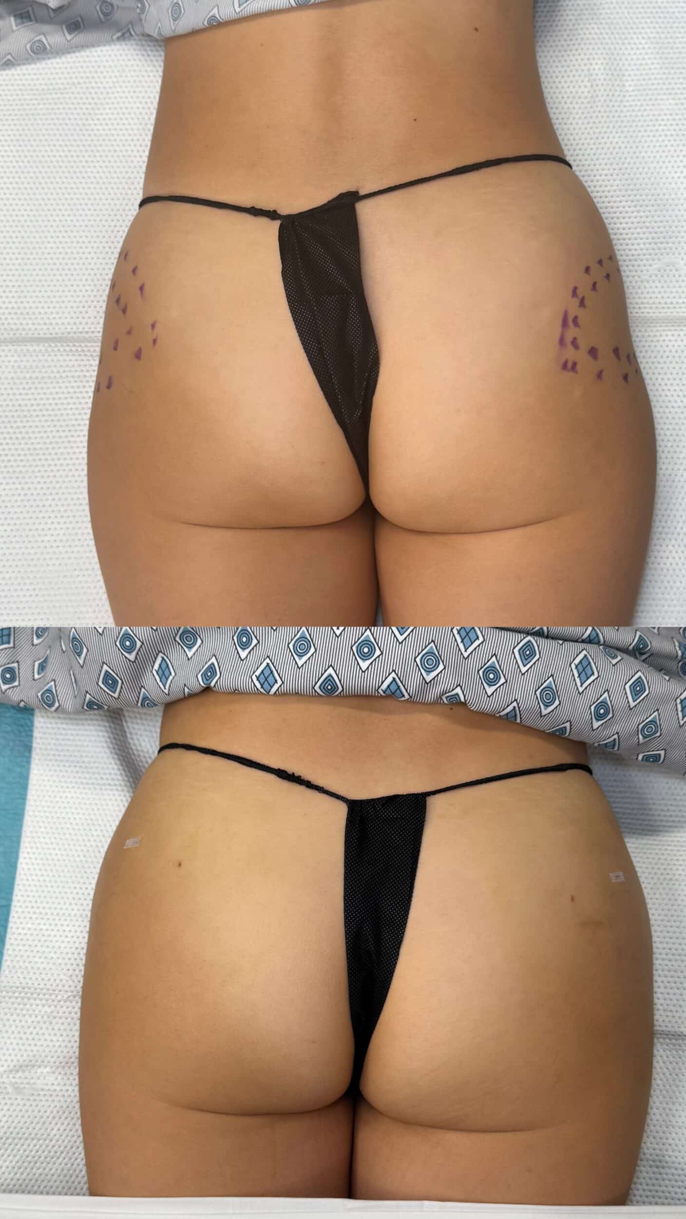 Hip Dip Treatment with AlloClae