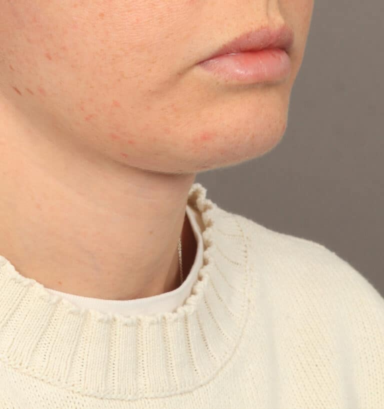 After Image: Deep Plane Face & Neck Lift (1 Year Post-Op) - right-front-oblique