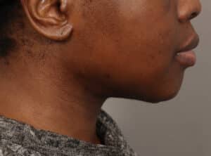After Image: Submentoplasty (2 Weeks Post-Op)
