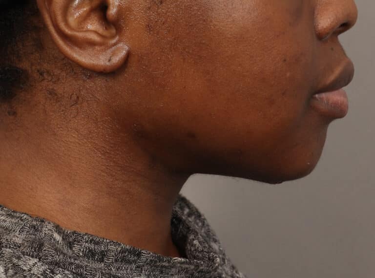 After Image: Submentoplasty (2 Weeks Post-Op) - right-side