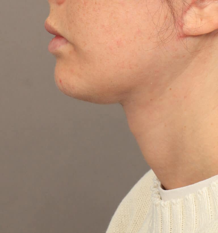After Image: Deep Plane Face & Neck Lift (1 Year Post-Op) - left-side