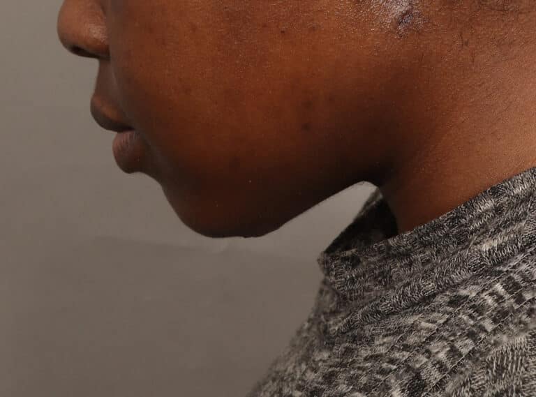 After Image: Submentoplasty (2 Weeks Post-Op) - left-side