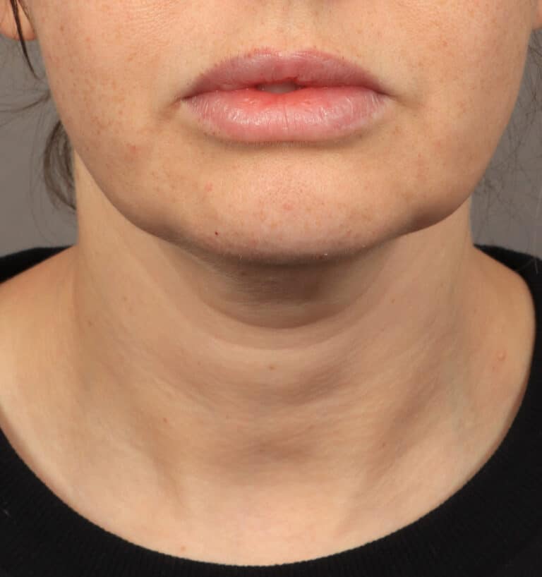 Before Image: Deep Plane Face & Neck Lift (1 Year Post-Op) - front