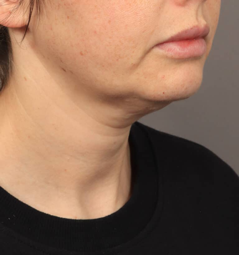 Before Image: Deep Plane Face & Neck Lift (1 Year Post-Op) - right-front-oblique