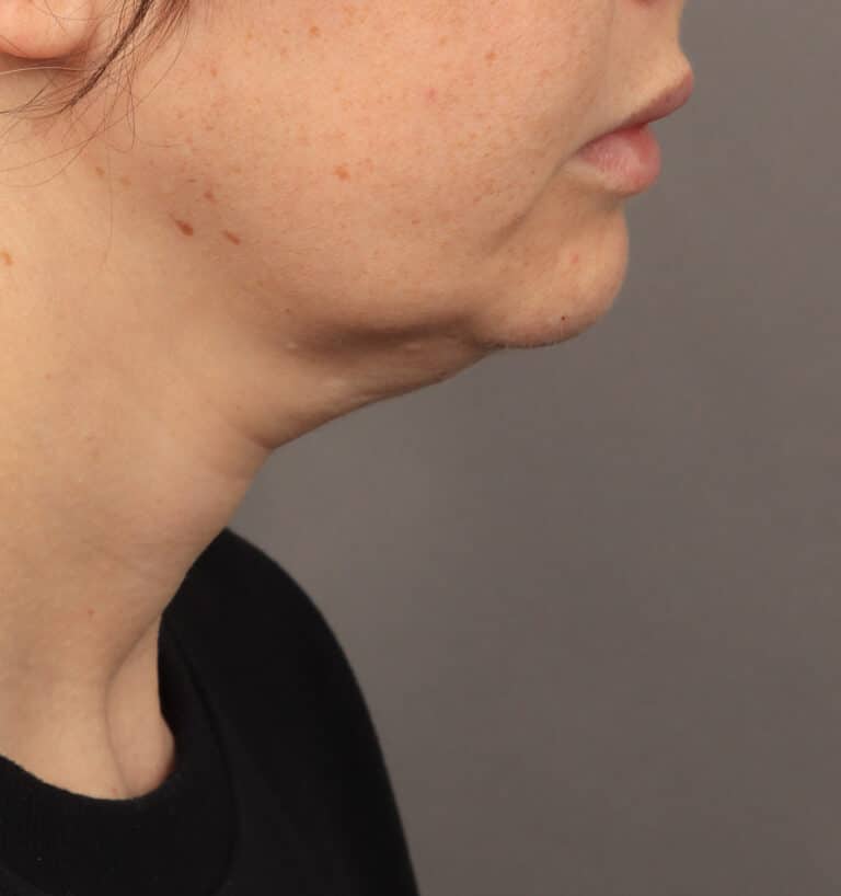 Before Image: Deep Plane Face & Neck Lift (1 Year Post-Op) - right-side