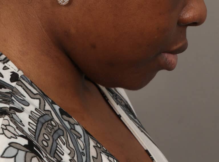 Before Image: Submentoplasty (2 Weeks Post-Op) - right-side