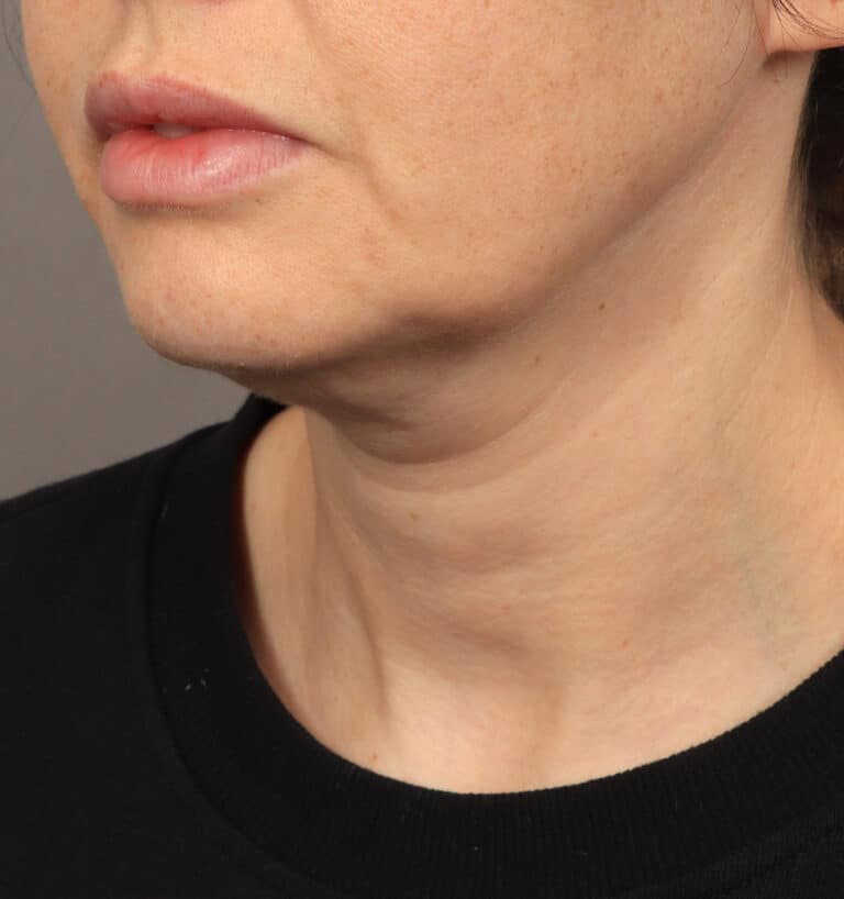Before Image: Deep Plane Face & Neck Lift (1 Year Post-Op) - left-front-oblique