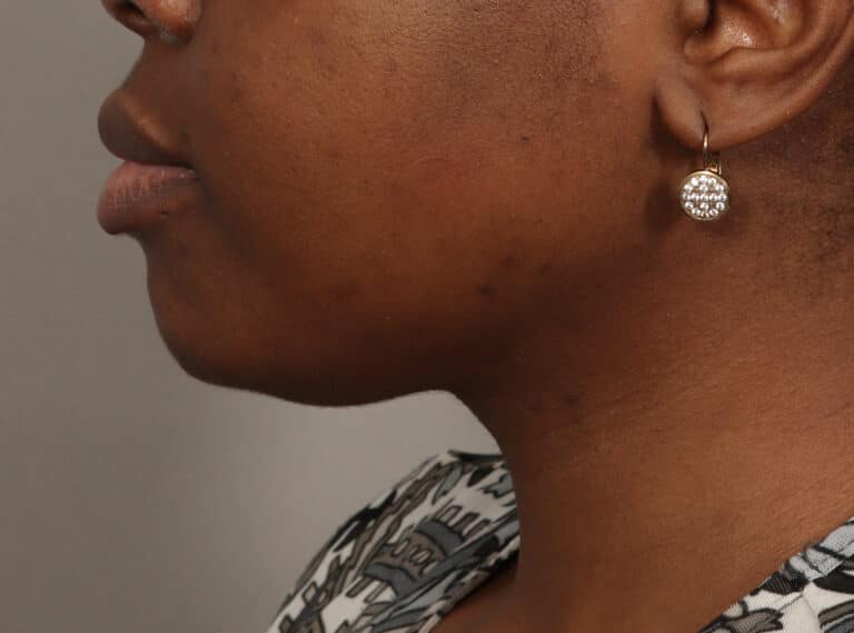 Before Image: Submentoplasty (2 Weeks Post-Op) - left-side