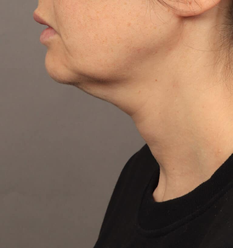 Before Image: Deep Plane Face & Neck Lift (1 Year Post-Op) - left-side