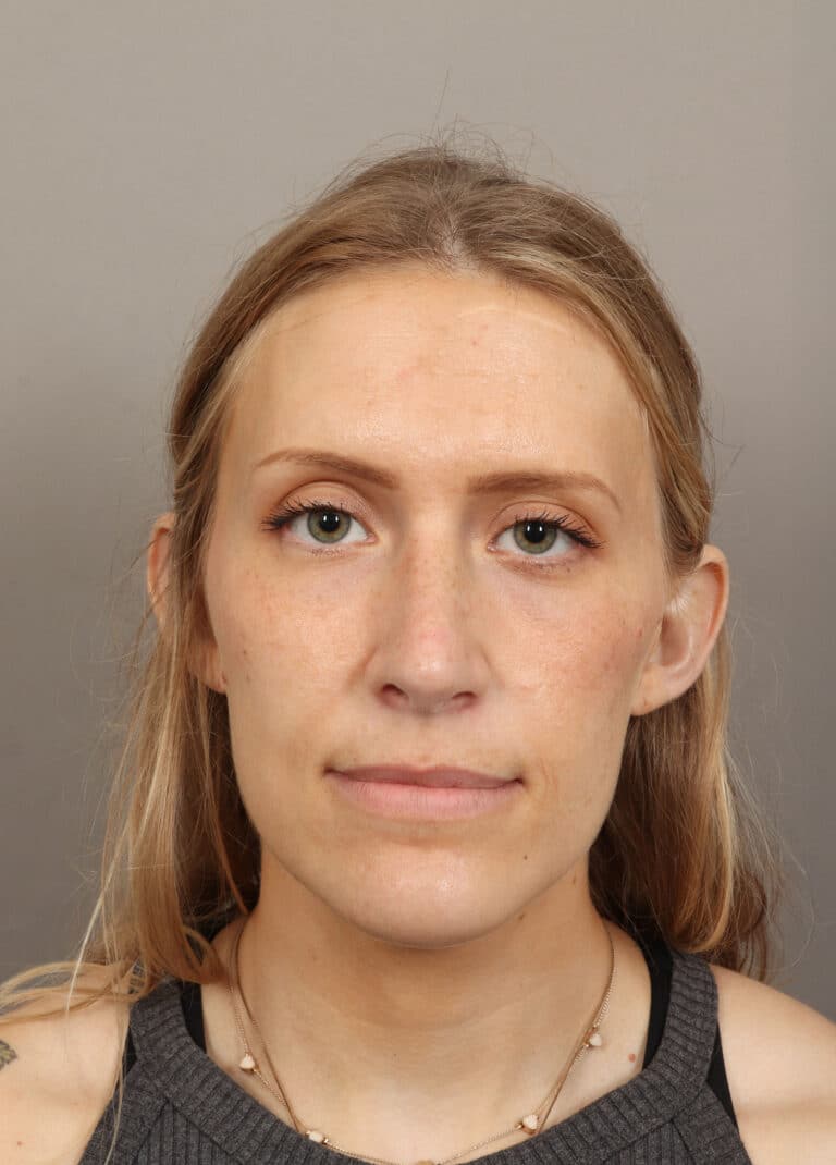 After Image: Rhinoplasty (6 Months Post-Op) - front