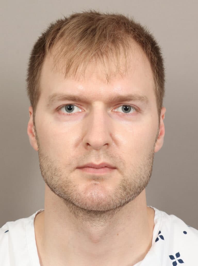 After Image: Jaw and Chin Augmentation (1 Year, 9 Months Post-Op) - front