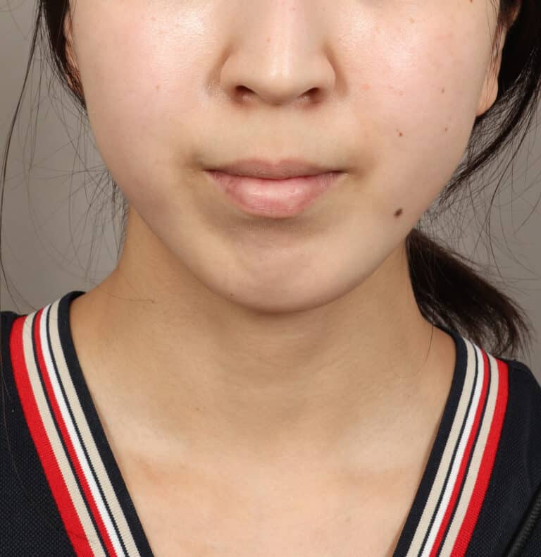 After Image: Genioplasty – Chin Implant (5 Months Post-Op) - front