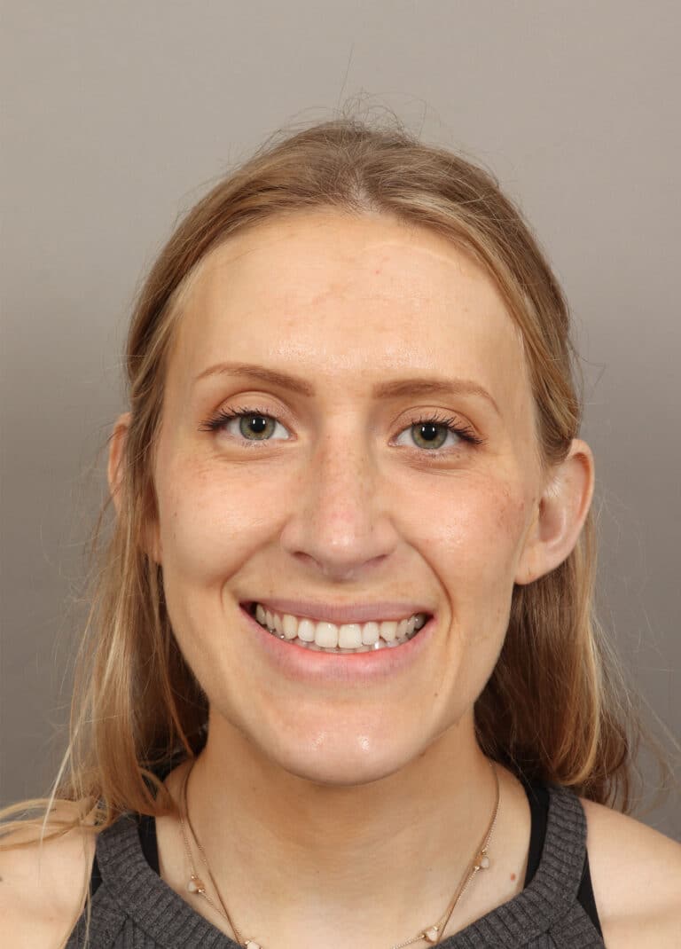 After Image: Rhinoplasty (6 Months Post-Op) - front