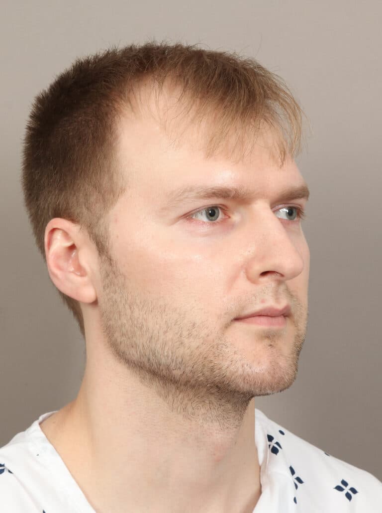 After Image: Jaw and Chin Augmentation (1 Year, 9 Months Post-Op) - right-front-oblique
