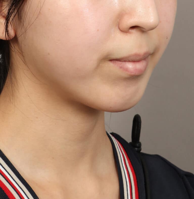 After Image: Genioplasty – Chin Implant (5 Months Post-Op) - right-front-oblique