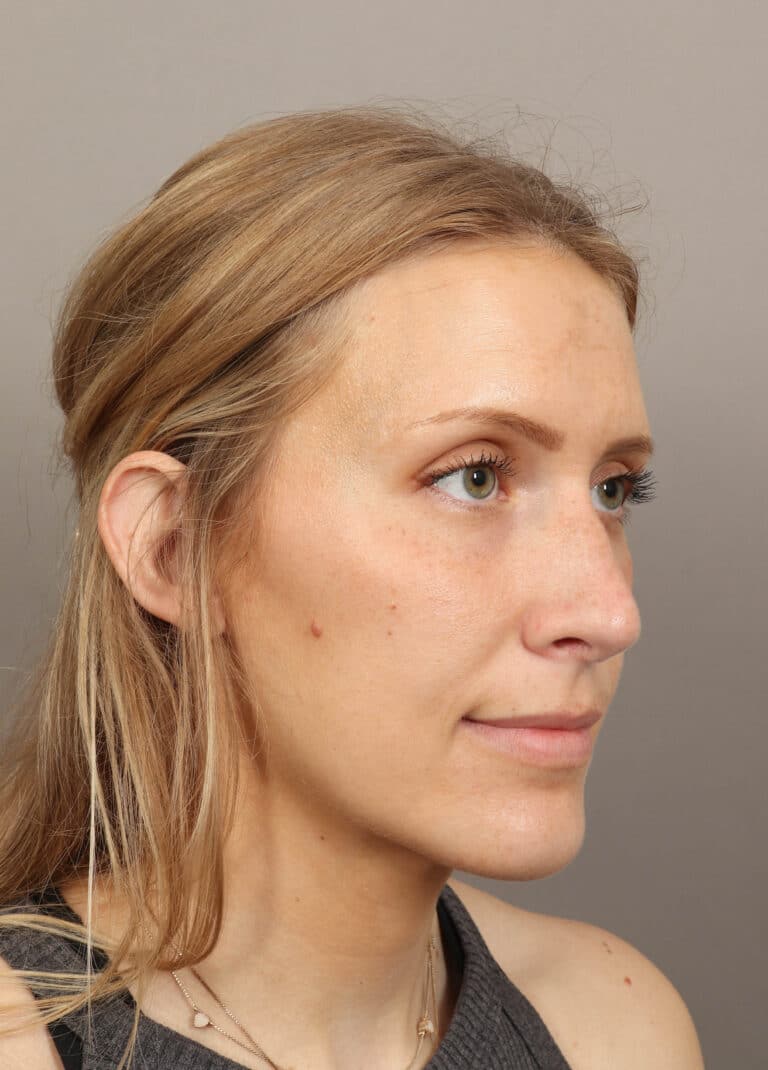 After Image: Rhinoplasty (6 Months Post-Op) - right-front-oblique