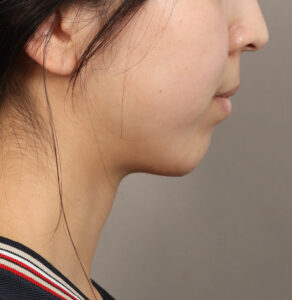 After Image: Genioplasty – Chin Implant (5 Months Post-Op)