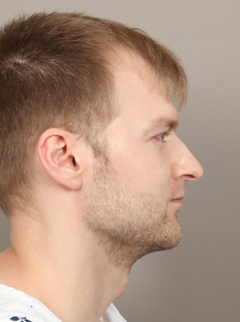 After Image: Jaw and Chin Augmentation (1 Year, 9 Months Post-Op) - right-side