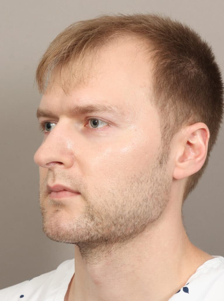After Image: Jaw and Chin Augmentation (1 Year, 9 Months Post-Op) - left-front-oblique