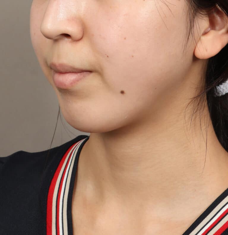After Image: Genioplasty – Chin Implant (5 Months Post-Op) - left-front-oblique