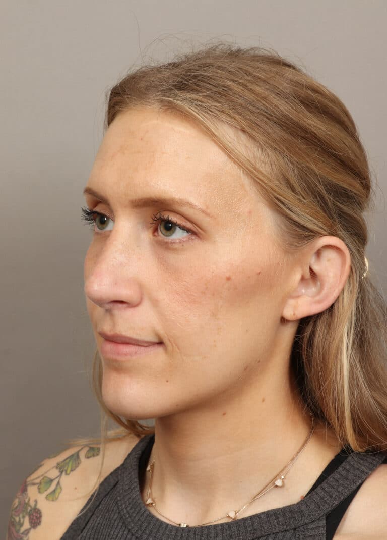 After Image: Rhinoplasty (6 Months Post-Op) - left-front-oblique