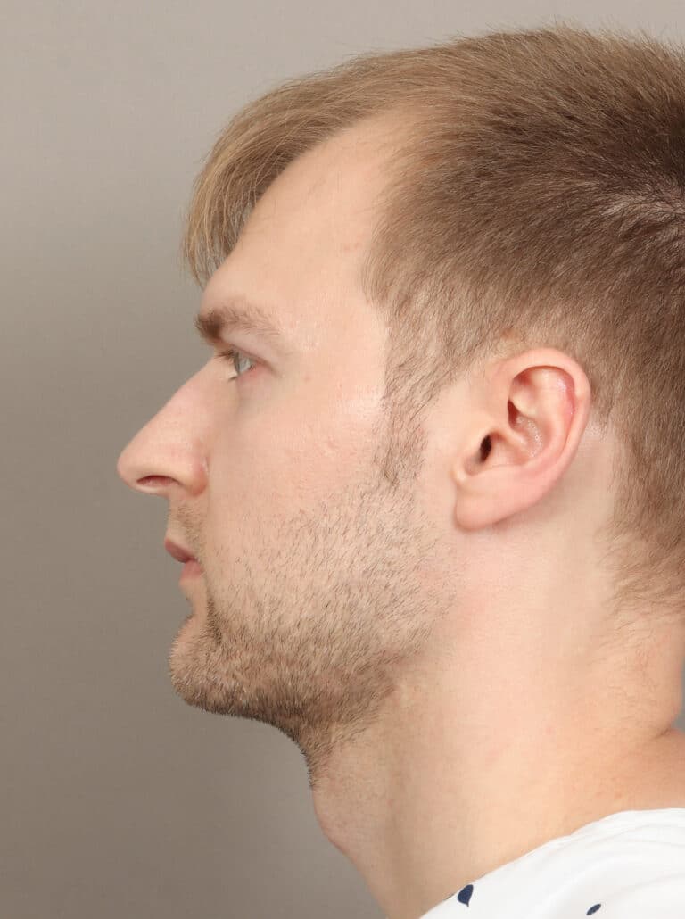 After Image: Jaw and Chin Augmentation (1 Year, 9 Months Post-Op) - left-side