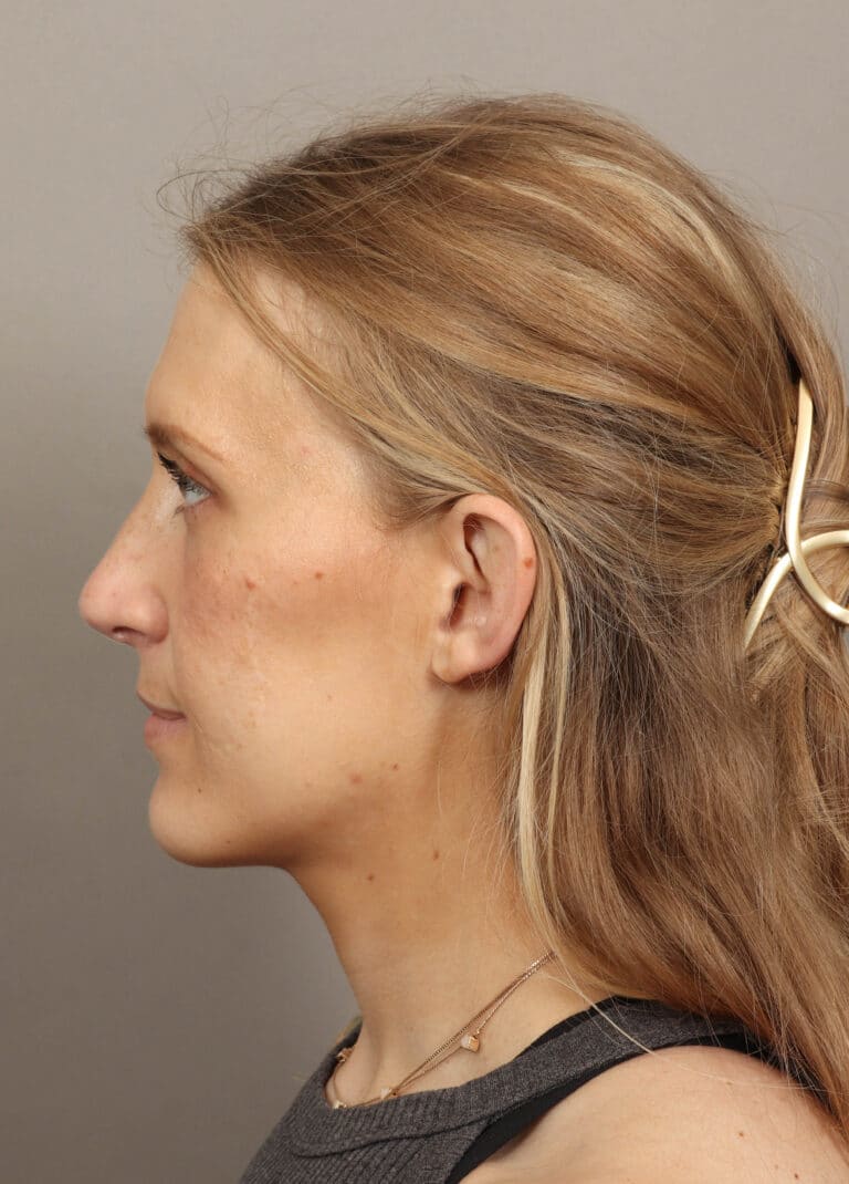 After Image: Rhinoplasty (6 Months Post-Op) - left-side
