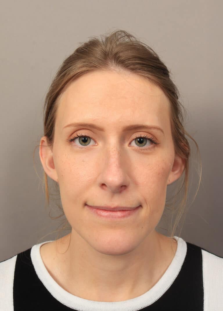 Before Image: Rhinoplasty (6 Months Post-Op) - front
