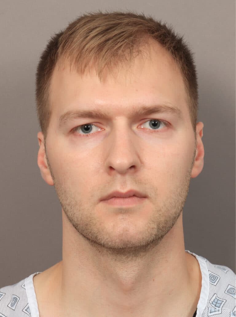 Before Image: Jaw and Chin Augmentation (1 Year, 9 Months Post-Op) - front