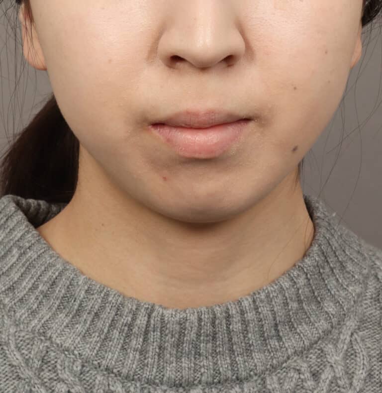 Before Image: Genioplasty – Chin Implant (5 Months Post-Op) - front