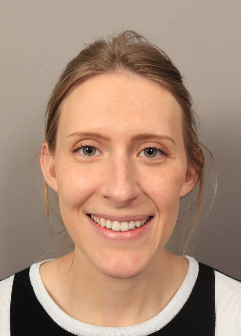 Before Image: Rhinoplasty (6 Months Post-Op) - front