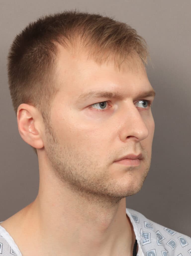 Before Image: Jaw and Chin Augmentation (1 Year, 9 Months Post-Op) - right-front-oblique